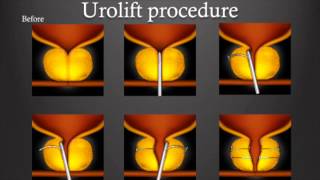 Urolift vs Greenlight therapy for BPH  whats right for you [upl. by Keeler]