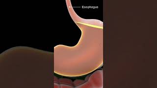 Understanding Achalasia Cardia  Causes amp Solutions [upl. by Arabrab267]