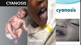 CYANOSIS  Central peripheral differential and pseudo cyanosis [upl. by Yeliah981]