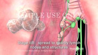 Lung Cancer Staging NonSmall Cell [upl. by Rodrique280]