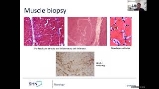 Dermatomyositis clinical case and treatment [upl. by Risser]