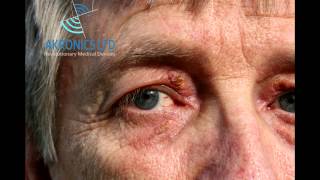 Xanthelasma Removal without TCA [upl. by Tamberg]