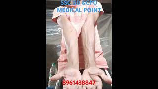 SSC GD ampCPO MEDICAL POINT  carrying angel cubitusvalgus sscgd [upl. by Kenyon]