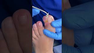 DEDO CON FIBROMA ingrowntoenailsurgery [upl. by Araht]