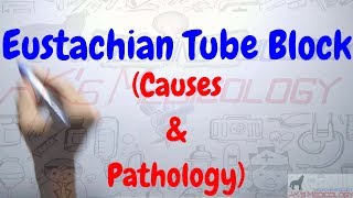 Eustachian Tube Block Causes amp Pathology with clinical case  AKs Medicology [upl. by Tterraj]