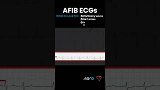 What to Look for in AFib ECG [upl. by Aicelav329]