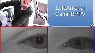 Left Anterior Canal BPPV [upl. by Aihceyt]