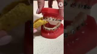 what to eat what not to eat braces malayalam pallil kambi idunnath  aligners  viral palludr [upl. by Bergstein558]