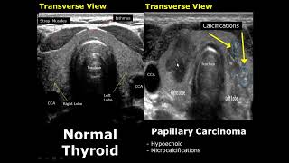 Thyroid Ultrasound Normal Vs Abnormal Image Appearances Comparison  Thyroid Pathologies USG [upl. by Erlene]