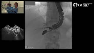 Transhepatische Metallstentplatzierung mit Dislokation [upl. by Atikihs]