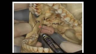 المحاضرة التاسعة  الجزء الاول LOCAL ANESTHESIA7 COMPLICATIONS OF LA [upl. by Muncey]