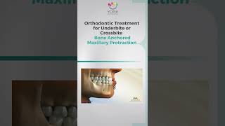 Orthodontic Treatment for Underbite or Crossbite Bone Anchored Maxillary Protraction [upl. by Clava]