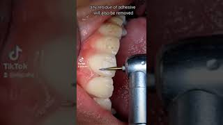 Polishing teeth after bracket removal  Braces Removal [upl. by Ahscrop]