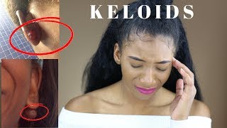 My Keloid Story EXPLICIT with Photos How to get rid of them  What are they  Annesha Adams [upl. by Ailecra]