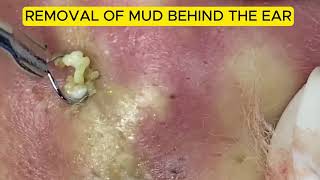 REMOVAL OF MUD BEHIND THE EAR DERMATOLOGY DREAMS [upl. by Aivilo]