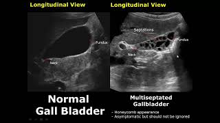 Gallbladder Ultrasound Normal Vs Abnormal Image Appearances Comparison  Gallbladder Pathologies USG [upl. by Nehemiah]