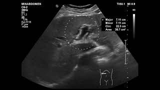 acute cholecystitis amp periportal halo [upl. by Neryt]