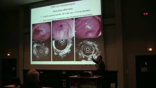 Aspect en endoscopie et échoendoscopie des tumeurs sousmuqueuses digestives  Dr L PALAZZO Paris [upl. by Tala]