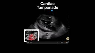 Cardiac Tamponade PSLA [upl. by Woodcock]