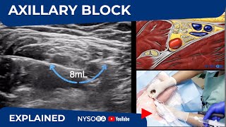 Ultrasound Guided Axillary Brachial Plexus Block NYSORA Regional Anesthesia [upl. by Sarette994]