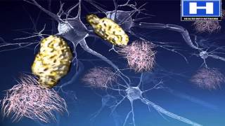 Alzheimers disease Pathophysiology Symptoms Causes and Treatment  3D animation [upl. by Heddi]