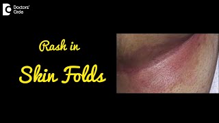 INTERTRIGO  Rash in Skin Folds  Causes Symptoms and Treatment  DrNischal K C  Doctors Circle [upl. by Harimas]