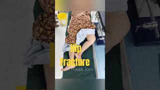 Hip Fracture Surgery  Intertrochanteric Fracture Femur  Proximal Femur Nail  Dr Prateek Joshi [upl. by Etteinotna417]