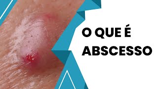 Descubra Tudo Sobre Abscesso e Como Tratar [upl. by Mirilla]