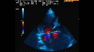 Atrial Septal Defects by D Bailly  OPENPediatrics [upl. by Einahc737]