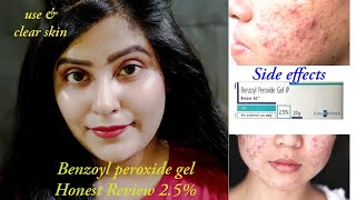 Benzoyl peroxide gel Use amp side effect  get for Acne  pimples  Supriya the classy tips [upl. by Skoorb]