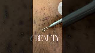 Ingrown Hair Removal Part 1 [upl. by Marpet]