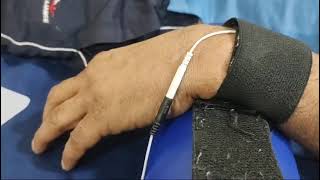 Electrical Stimulation as Treatment for Wrist Drop  Redial Nerve Palsy [upl. by Sudnak]