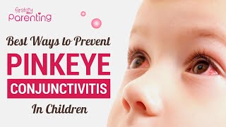 How to Prevent and Treat Conjunctivitis in Children [upl. by Euqinad608]