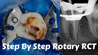 Live Steps Root Canal Rotary Protaper Endodontic Procedure ACP BMP obturation irrigation [upl. by Saihttam]