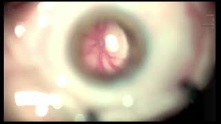 Alcon Ngenuity DOF in aphakic eye Lukan Mishev [upl. by Ahsieit]