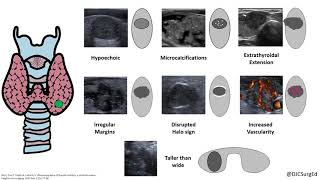 Thyroid Nodules [upl. by Atiraj]