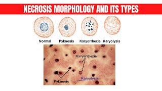 Necrosis Morphology and its types Part 3  Physio Class [upl. by Kyle]