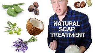 Alexs DIY All Natural Scar Treatment Tutorial [upl. by Jabe]