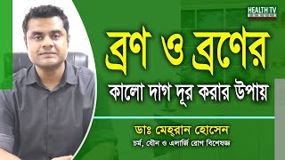 ব্রণ ও ব্রণের কালো দাগ দূর করার উপায়  Acne Treatment  Dr Mehran Hossain  Health Tv Bangla [upl. by Selwin783]