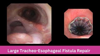 Large Tracheo  Esophageal Fistula  Bronchoscopic Repair [upl. by Saunderson495]