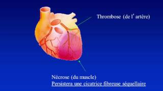 5 à 7 Dépister et prévenir linsuffisance cardiaque [upl. by Aivekahs]