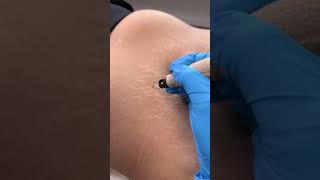 Stretch Marks Inkless Removal Boleyn Treatment Los Angeles 🌍 shorts [upl. by Beau228]