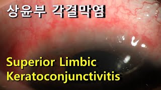 상윤부 각결막염 Superior Limbic Keratoconjunctivitis [upl. by Isiad]