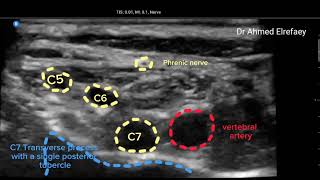 Interscalene block ultrasound scanning know where the dangerous structures are [upl. by Enovi]