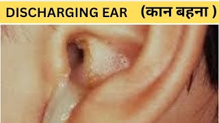 Ear Discharge  कान का बहना  cause  Symptoms  Treatment  Hindi [upl. by Kenward]