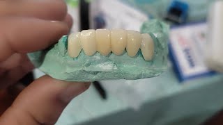 ILYAS AHMAD  The Abutment Crown is live Doing Patient At My Clinic [upl. by Atsok]