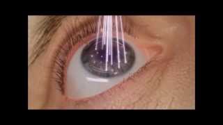 LASIK 100 laser  étape de photoablationwmv [upl. by Anaitsirk385]