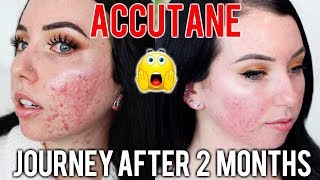 MY ACCUTANE JOURNEY 2 MONTH UPDATE Before amp After Side Effects Skin Care Products Im using [upl. by Nohsram]