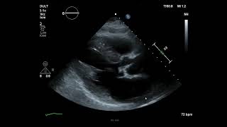 Transthoracic echo showing an aortic valve vegetation [upl. by Arimak941]