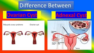 Difference Between Ovarian cyst and Adnexal Cyst [upl. by Ainahpets]